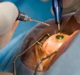 Advance Cataract Surgery