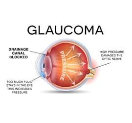 Glaucoma Services